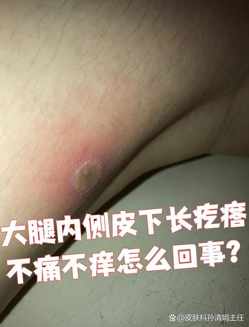 皮肤不痛不痒有硬疙瘩是何原因?