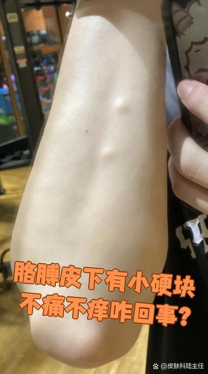 皮肤不痛不痒有硬疙瘩是何原因?