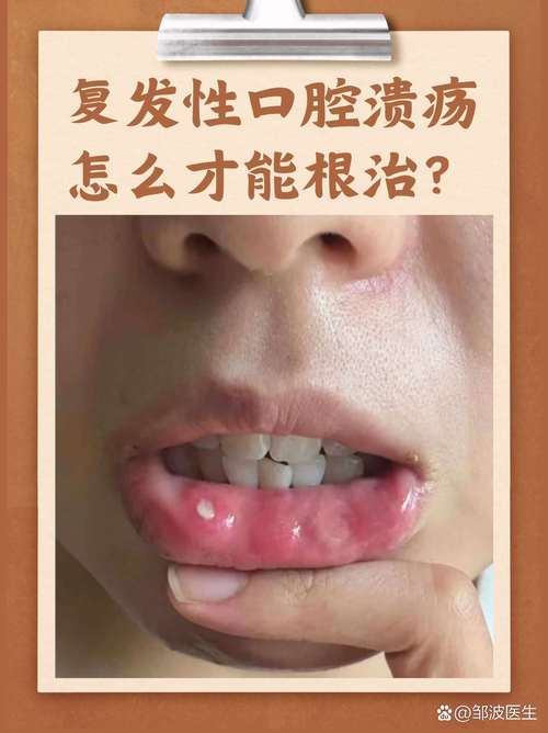 口腔溃疡反复发作该挂什么科?