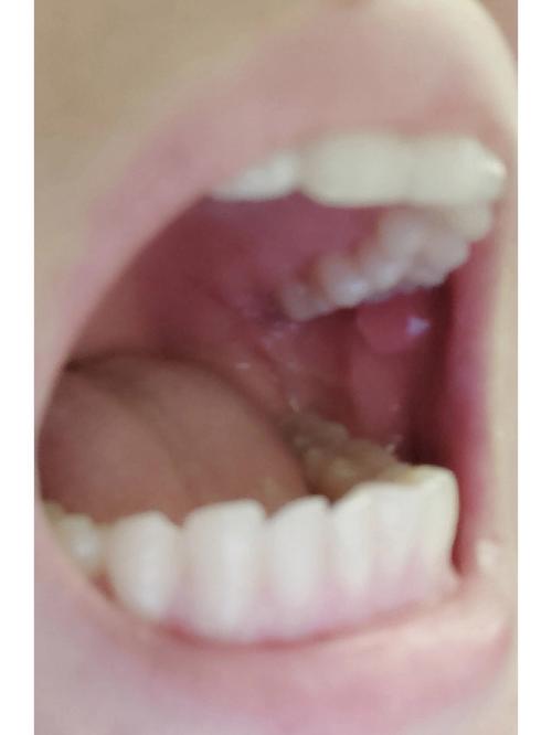 腮帮子内壁长肉凸起是啥原因?