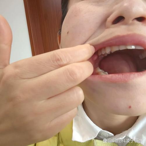 腮帮子内壁长肉凸起是啥原因?