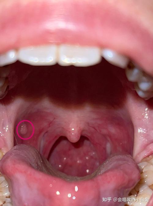 腮帮子内壁长肉凸起是啥原因?