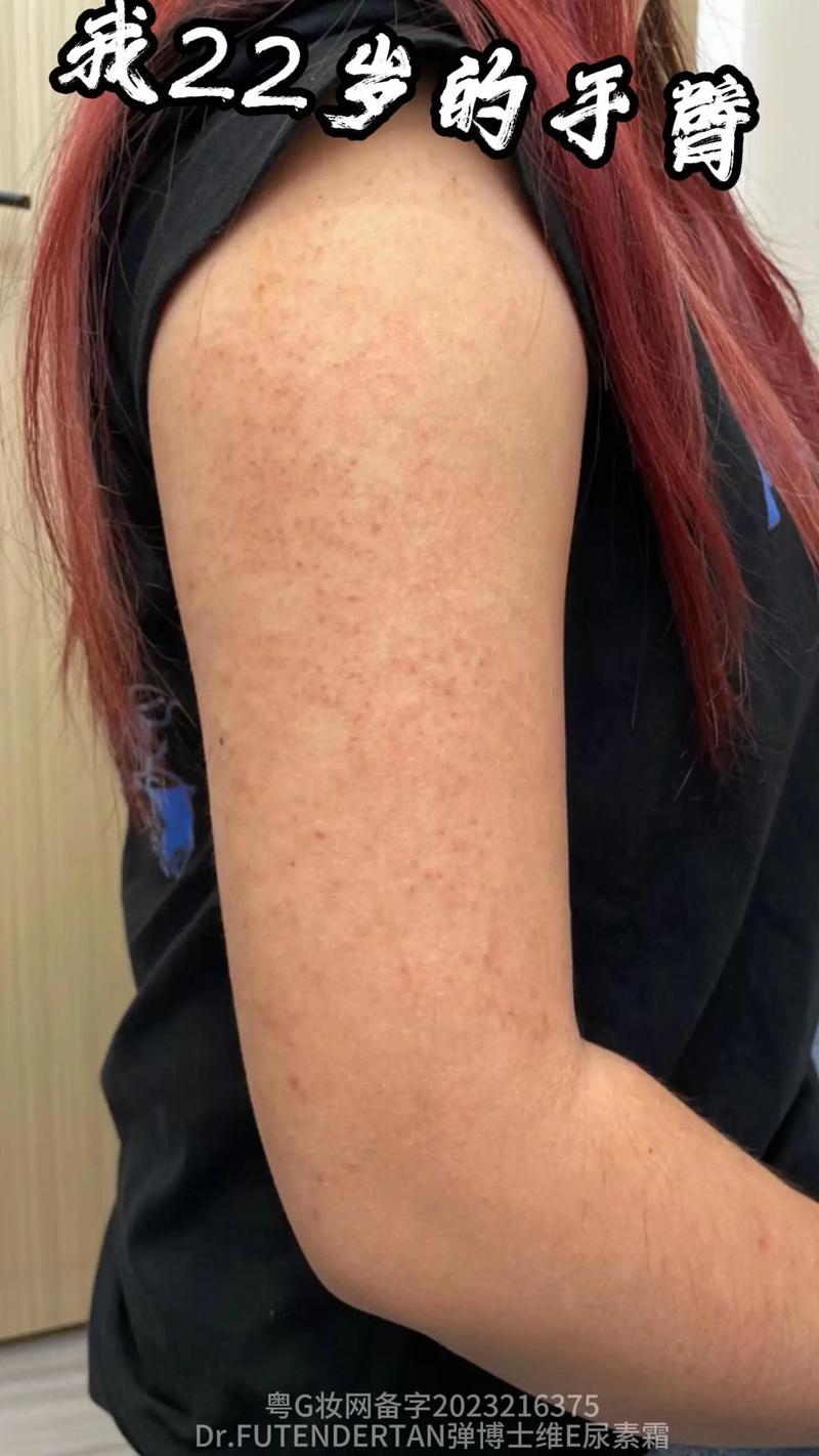 长期涂尿素霜,皮肤会变差吗?