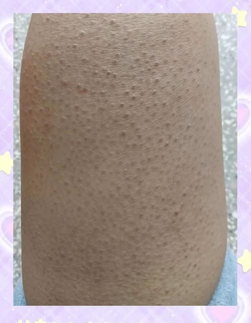 长期涂尿素霜,皮肤会变差吗?