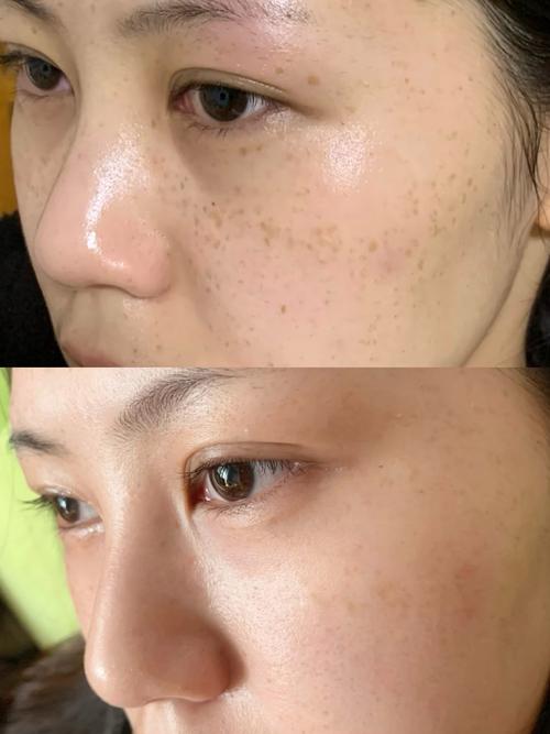 激光祛斑后多久皮肤能完全恢复如初?