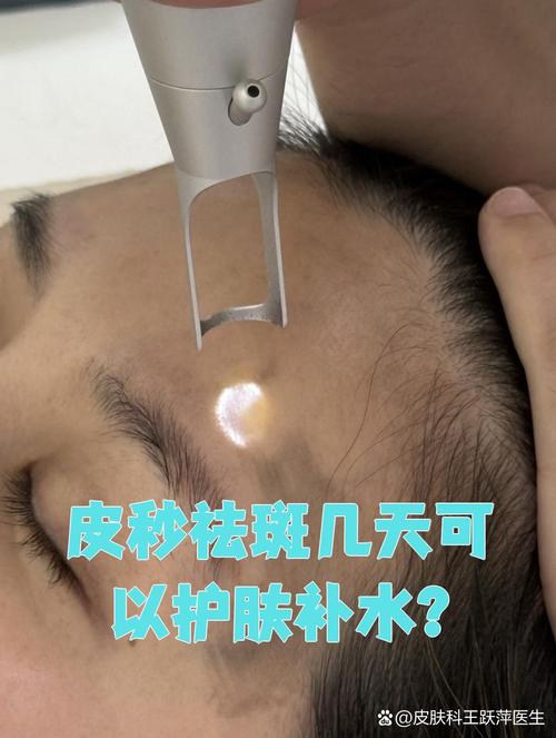 激光祛斑后多久皮肤能完全恢复如初?