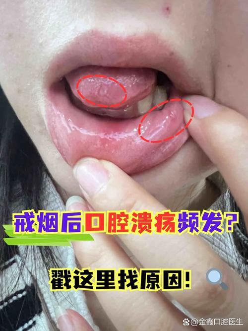 满嘴口腔溃疡反复发作,是身体哪里出问题了吗?
