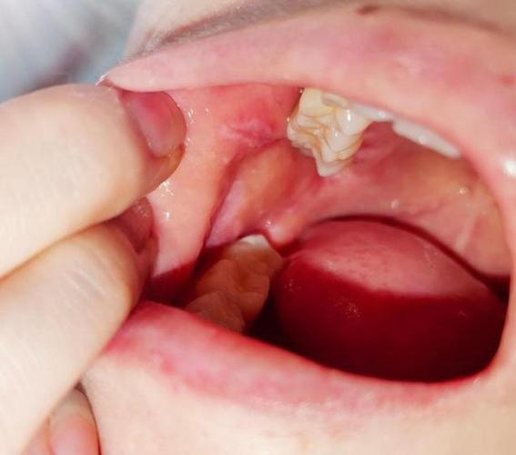 口腔扁平苔藓长哪里最危险?