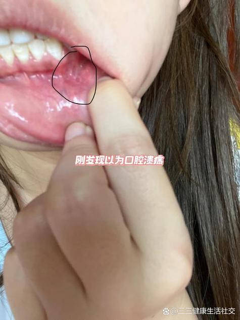 口腔扁平苔藓长哪里最危险?