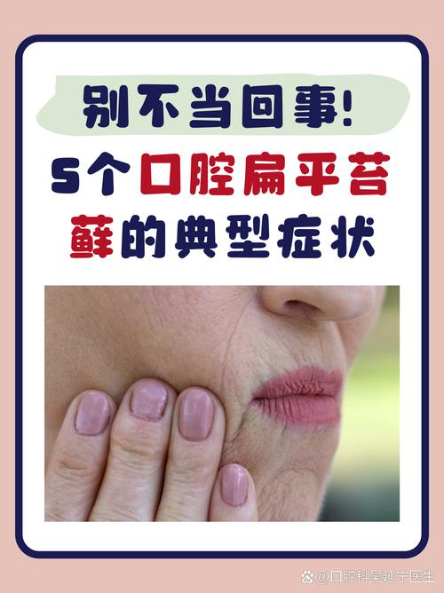 口腔扁平苔藓长哪里最危险?