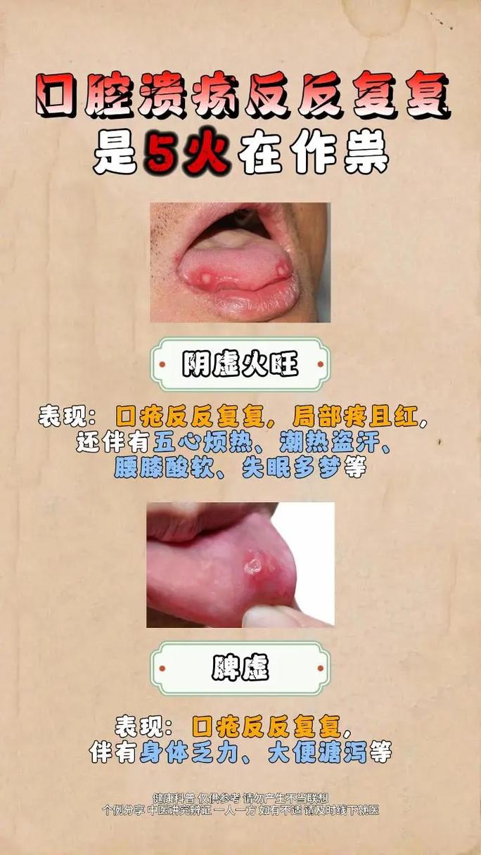 口腔溃疡实火虚火如何分辨?