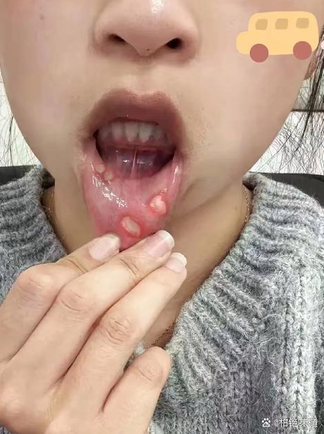 艾灸后口腔溃疡是湿气太重了吗?