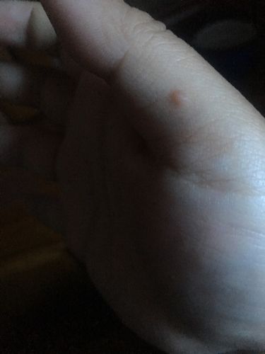 皮肤上长黑色疙瘩是何原因?