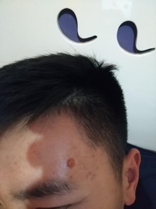 皮肤上长黑色疙瘩是何原因?