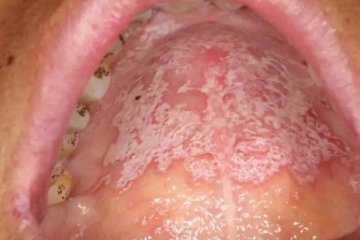 口腔白色念珠菌感染症状图片有哪些表现?