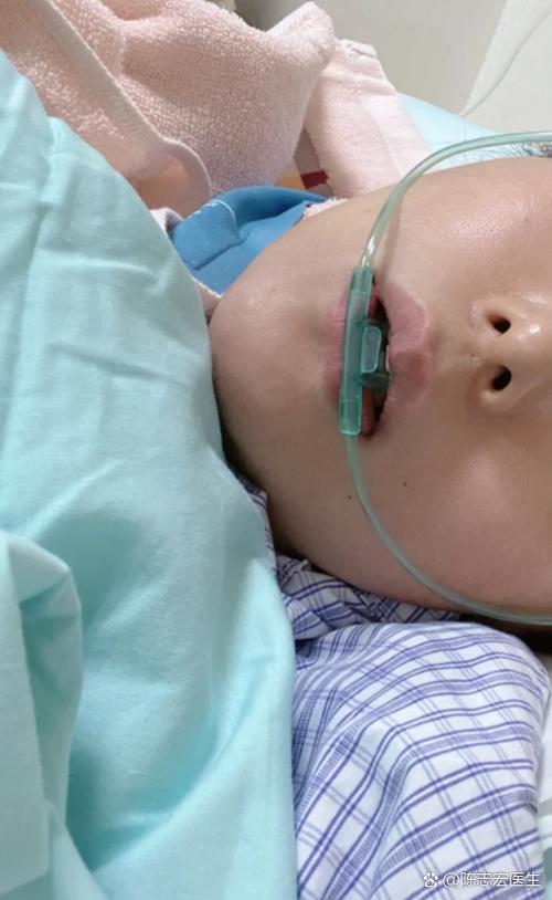 口腔缝针后几天能正常吃东西?