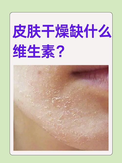 皮肤干燥瘙痒,缺哪种维生素?