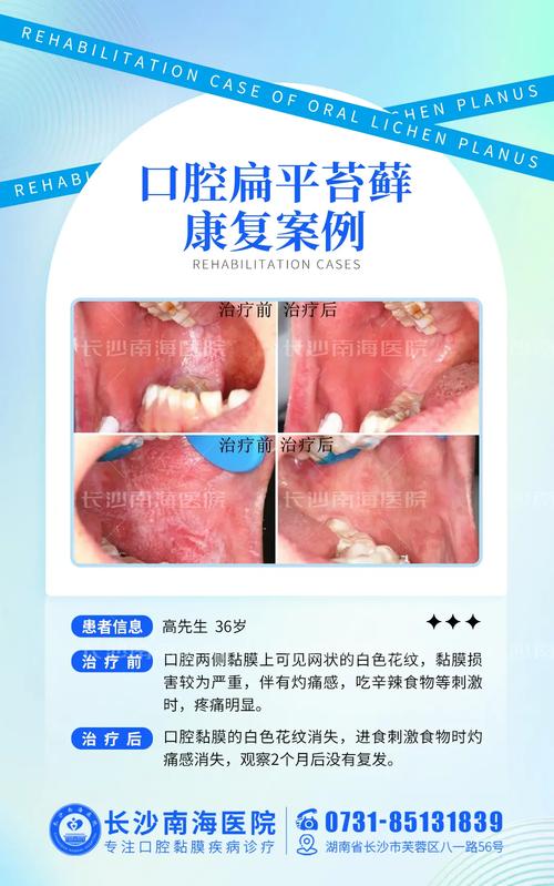 口腔扁平苔藓,哪种方法治疗最有效?