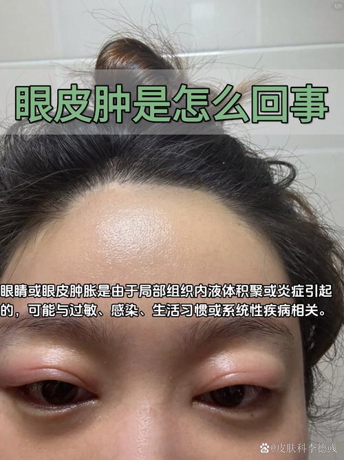 眼周红肿发痒是过敏还是其他问题?