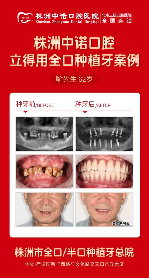 牙齿种植医院怎么选?