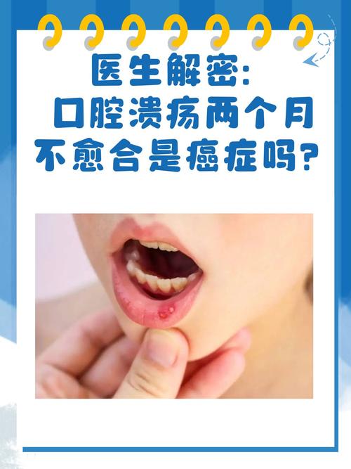 每个月都口腔溃疡是怎么回事