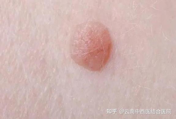 阴茎根部皮肤内肉疙瘩是何原因?