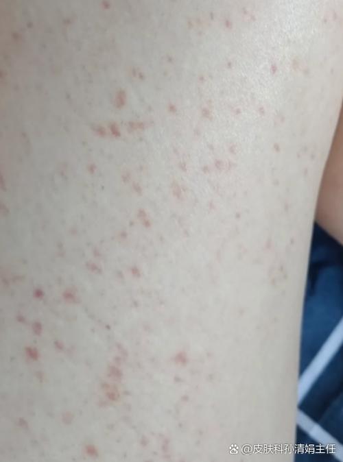 皮肤痒一挠起红点红块是过敏还是什么问题?