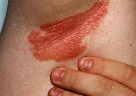 皮肤红斑不痛不痒是何问题?