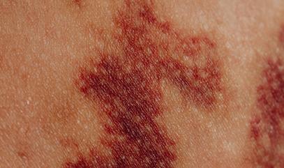 皮肤红斑不痛不痒是何问题?