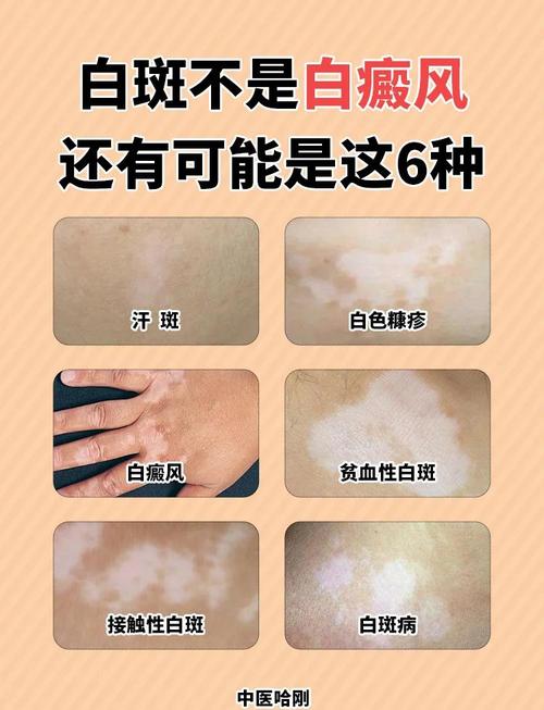 皮肤白色斑块是啥病?咋引起的?