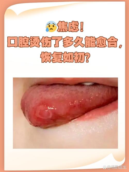 口腔灼热感是啥原因引起的?