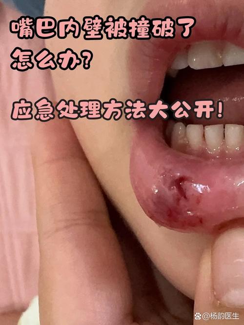 嘴咬破成口腔溃疡,如何快速好?