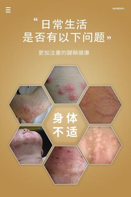 皮肤红疙瘩痒,抹什么药能快速止痒?