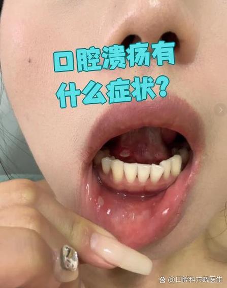 口腔溃疡会引起淋巴结肿大吗