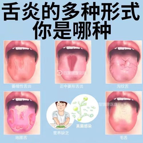 维生素B2真能治口腔溃疡吗?