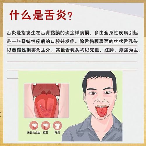 口腔溃疡吃维生素B2真的有用吗?