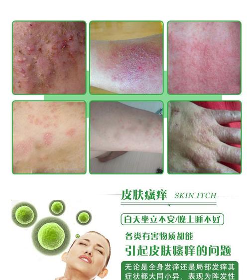 大腿内侧瘙痒,该用啥药?