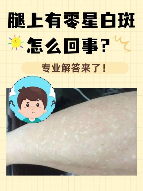 皮肤白色斑点是何原因?