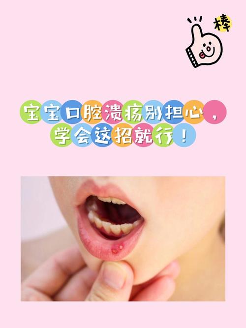 两岁多宝宝口腔溃疡怎么办