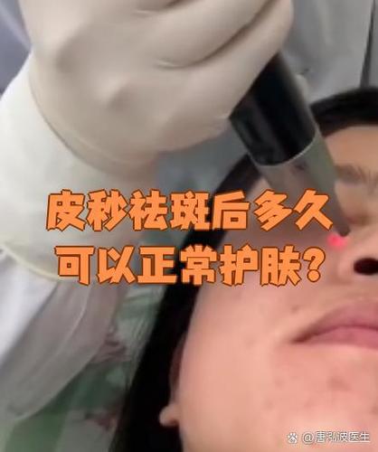 激光祛斑后多久皮肤能恢复正常?