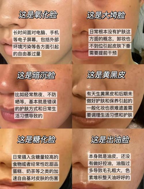 油性皮肤怎么变成中性皮肤