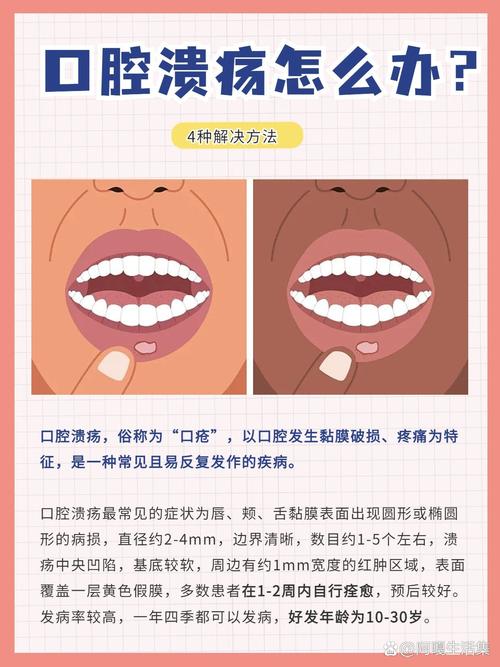 口腔溃疡反复发作,究竟为何?