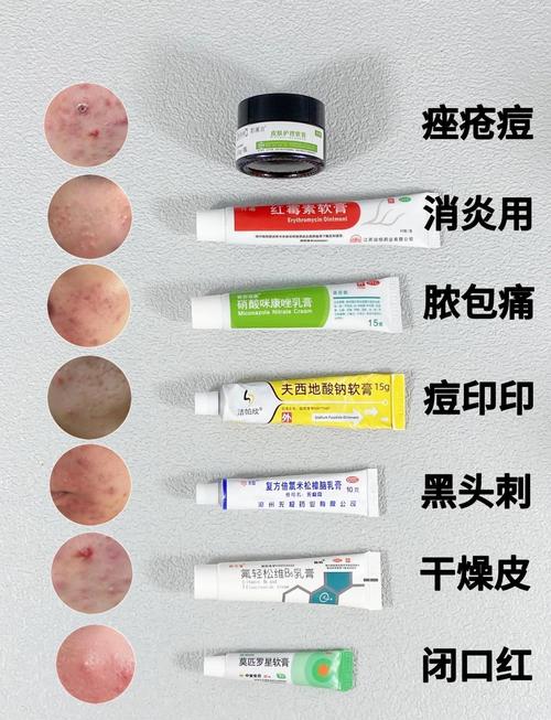 油痘肌护肤品选什么?