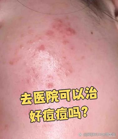 去医院皮肤科看痘痘有用吗