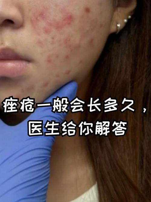 去医院皮肤科看痘痘有用吗