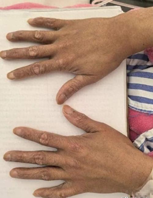 葡萄球菌皮肤烫伤样综合征