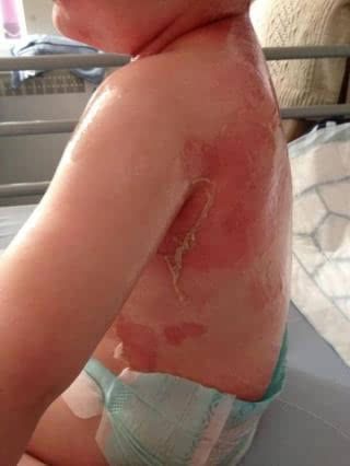 葡萄球菌皮肤烫伤样综合征