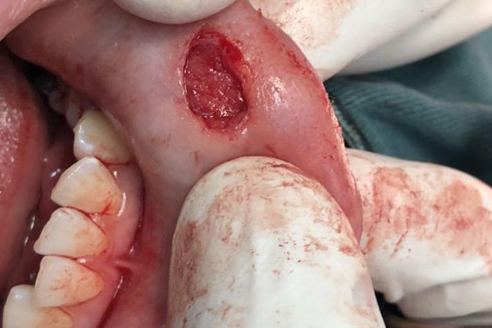 口腔粘液腺囊肿手术费用多少?