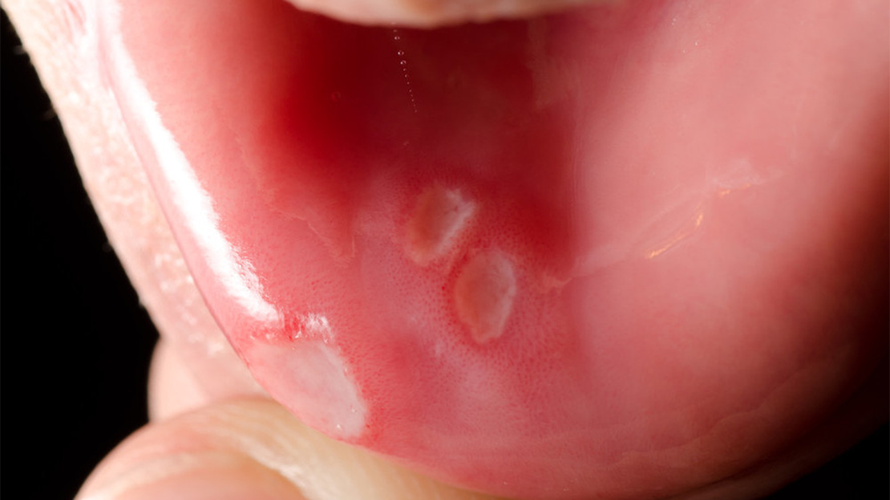 口腔白色东西是啥?要紧吗?