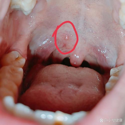 口腔咽喉感染hpv的症状